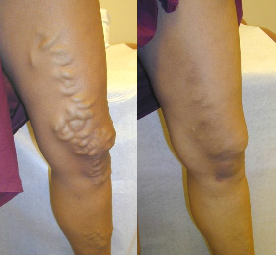 What Are the Types of Surgical Treatments for Varicose Veins