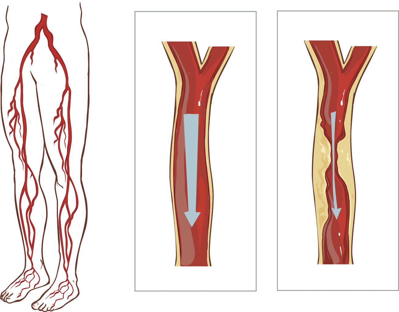 If you're considering sclerotherapy as a solution to varicose veins, it's helpful to understand what to expect.